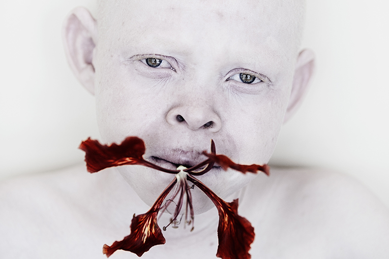 albinismo y concienciación