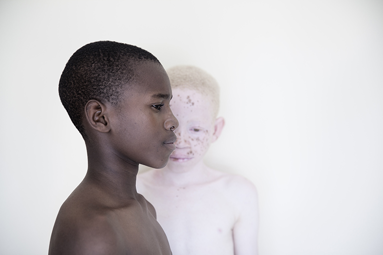 albinismo y concienciación